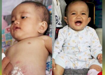 Kasihan, Balita Ini Lahir Tanpa Anus dan Ditinggal Ibu Pergi Selamanya... Balita Lahir Tanpa Anus-min