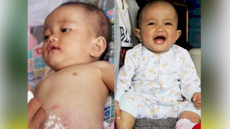 Balita Lahir Tanpa Anus-min